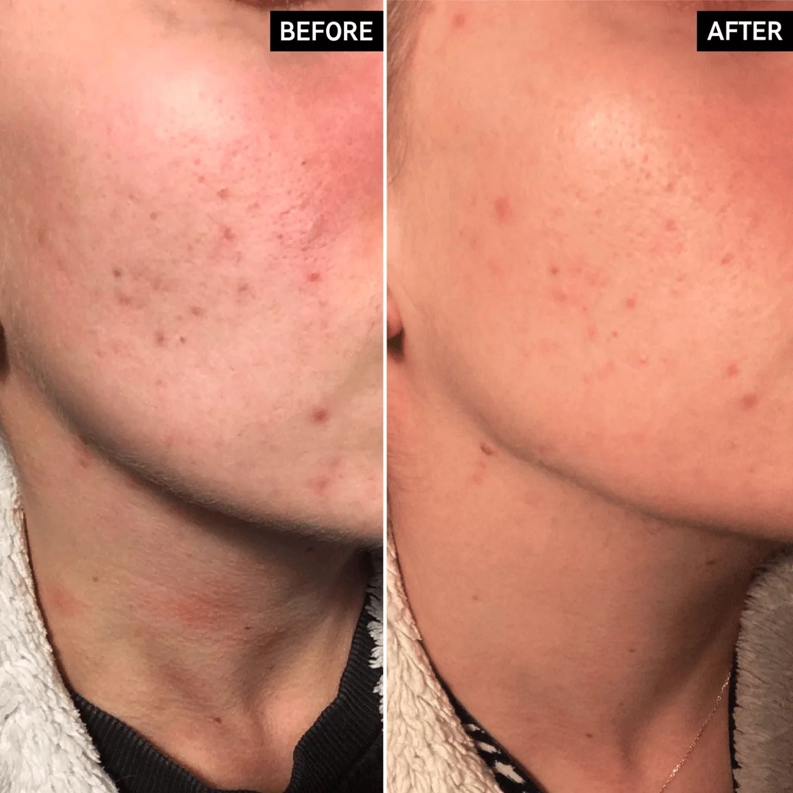 The Inkey List Apple cider  vinagar acid peel